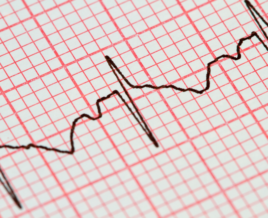 Eletrocardiograma (ECG): Para Que Serve e Quando Fazer?